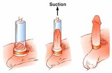 VACUUM ERECTION DEVICE.jpg