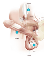 Penile-Implant-Page_Titan.png